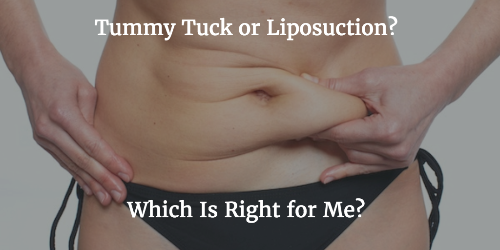 Liposuction vs Tummy Tuck: Which Is Right for Me? Dr. Bogue