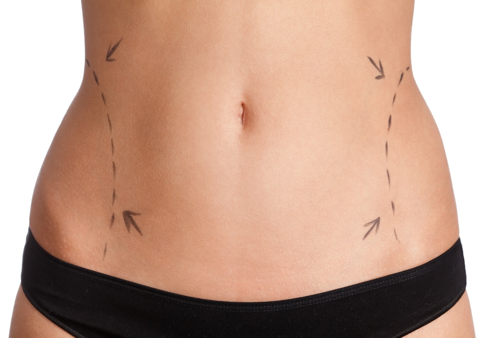 Body Contouring Surgery Cost