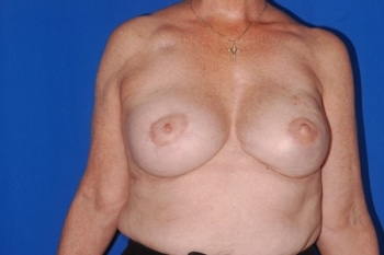 Before Image: Breast Reconstruction 5 - front