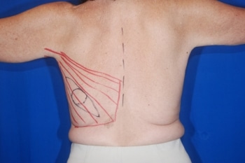 After Image: Breast Reconstruction 5 - front